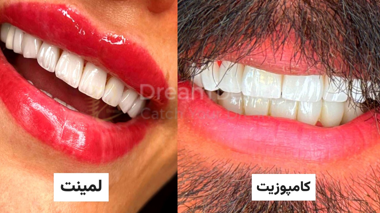 لمینت یا کامپوزیت؟ مقایسه هرکدام و بررسی 6 وجه تمایز 2 تصویر مقایسه لمینت سرامیکی و کامپوزیت دندان؛ دو روش محبوب اصلاح طرح لبخند